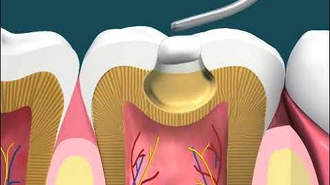 Dental Video of Amalgam Filling Large