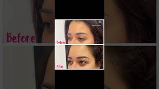 First Time Botox Brow Lift