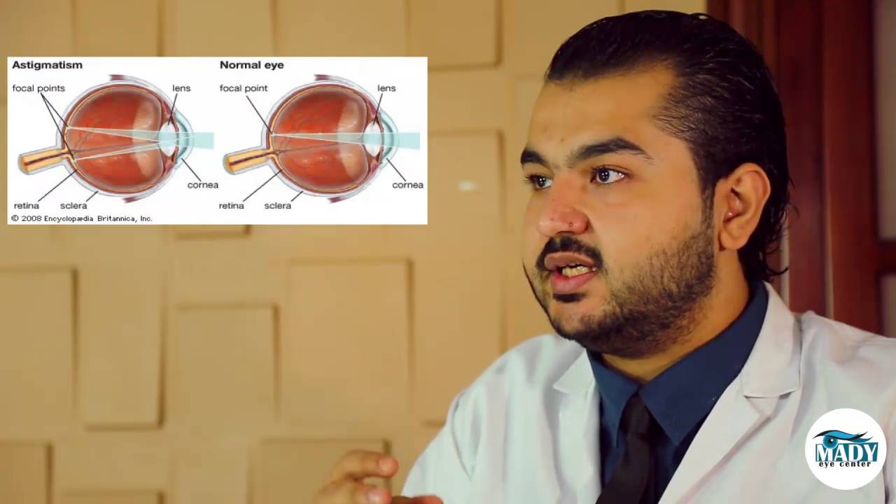 تعريف الاستجماتيزم  وعلاجة وعلاقتة بعمليات الليزك