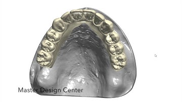3Shape - Upper Implant hybrid bridge design