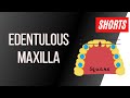 Treatment Planning for Edentulous Maxilla