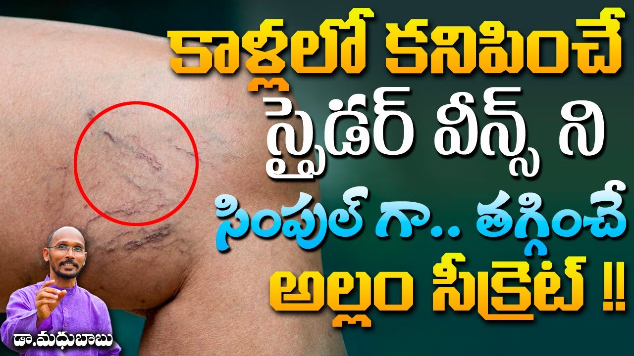 స్పైడర్ వీన్స్ ని సింపుల్ గా తగ్గించే అల్లం సీక్రెట్ | Dr. Madhu Babu | Health Trends |