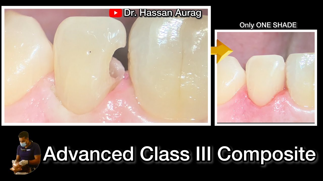 Углублённое препарирование и реставрация полостей III класса | Техника однотонного композита (CE ...