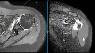 Massive rotator cuff tear in 58 year old