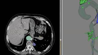 Abdominal Aorta AI Segmentation in DICOM Vision: AAA Measurements and Stent Analysis