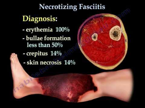 Necrotizing Fasciitis .Everything You Need To Know - Dr. Nabil Ebraheim