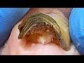 Toenail Curling Up With A Black Edge, Remove The Damaged Nail【Xue Yidao】