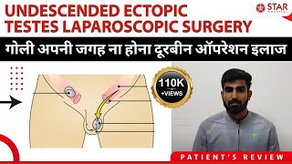 Undescended Ectopic Testes Laparoscopic Surgery Treatment गोली अपनी जगह ना होना दूरबीन ऑपरेशन इलाज