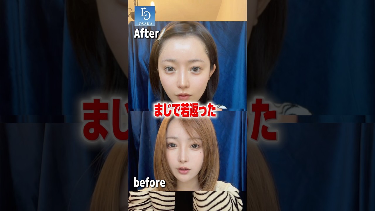糸リフト嫌だ‼️ってことで高周波でめちゃくちゃ若返った話