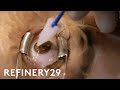 What Getting Laser Eye Surgery Is Really Like | Macro Beauty | Refinery29