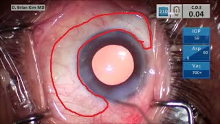 TBWTDCS #145: Slo-Mo Explanation of Double Chop in Soft Lens,  4 Clock Hrs Between Istent Inject W