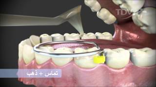 تماس   ذهب  CONTACT   GOLD TDV - Reconstruct Contact Points