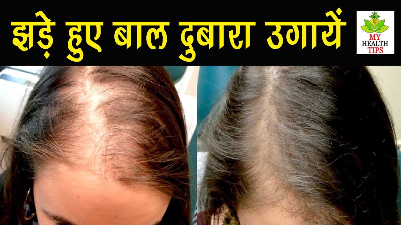 बल क दबर उगन क उपय naye baal kaise ugaye गजपन क इलज Hair  loss treatment  YouTube