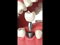 Is it better to get six dental implants or four dental implants?