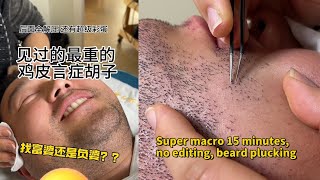 超微距 15分钟 无剪辑 拔胡子 太爽了！Super macro 15 minutes, no editing, beard plucking, so cool！