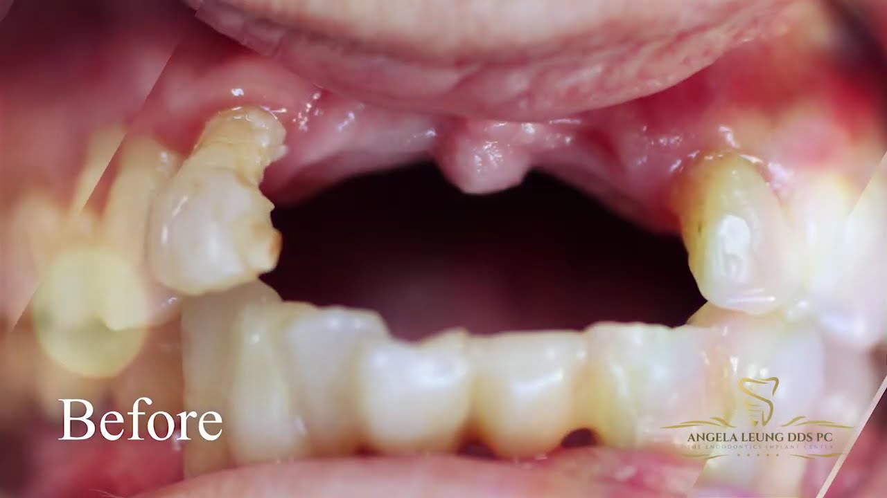 Multiple Dental Implants | Expert Care in San Francisco |  Angela Leung DDS PC