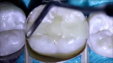 Bulk Fill Composites