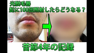 光脱毛器を髭に100回照射したらどうなる？4年以上かけて髭脱毛の効果を