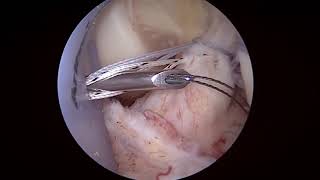 Knotless Primary Anterior Cruciate Ligament Repair with Adjustable Loop Device...
