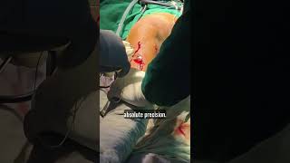 How I fix the ACL #aclreconstruction #aclsurgery #acl