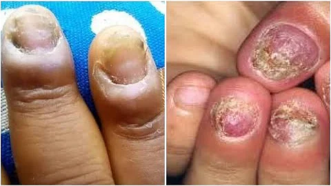 Hii ndio njia ya Kujikinga na kutibu Fangasi kwenye vidole/kucha|Tips to Prevent /cure nails fungus
