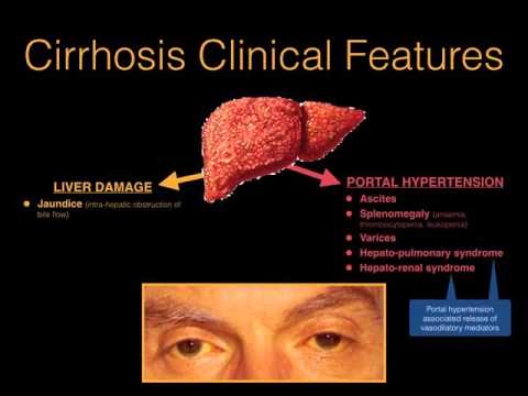 Chronic liver disease & cirrhosis - Dr. MDM - YouTube