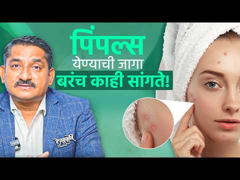 पिंपल्स का होतात? मूळ कारणं आणि घरगुती उपाय | Pimple Problem Explained | Dr. Harish Patankar