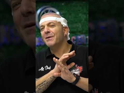 Hair transplant in Turkey - Italian celebrity