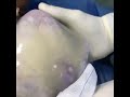 Twin birth, vaginal breech birth, encaul birth