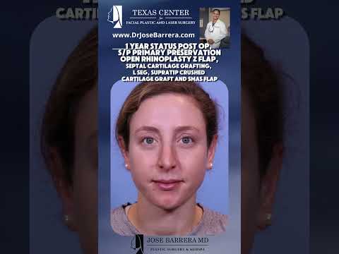 Video thumbnail: Primary Preservation Open Rhinoplasty with Z Flap, Septal Cartilage Grafting, L SEG, · Dr. Jose Barrera