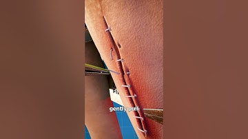 How Stitches Are Removed 🤔