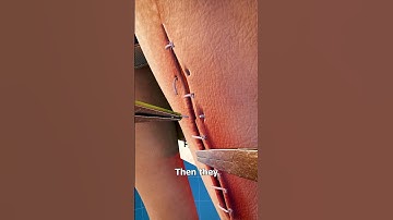 How Stitches Are Removed 🤔