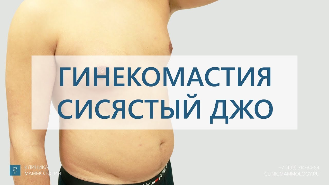 Гинекомастия. Сисястый Джо. Результат лечения гинекомастии. - YouTube
