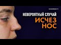 ИСЧЕЗ НОС. НЕВЕРОЯТНЫЙ СЛУЧАЙ. Nose disappeared. Difficult case/ KAMINSKYI