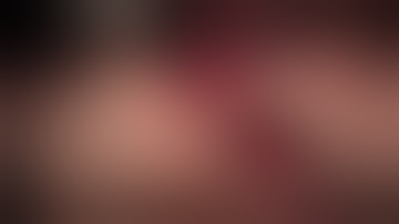 Lateral Ridge Augmentation #5 Site using Mineross and Ora-Mem