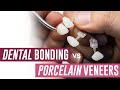 Dental Bonding vs Porcelain Veneers - Which Should I Get?