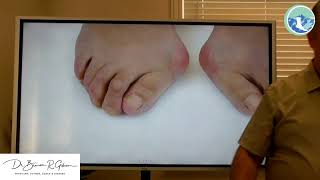 Bleeding Under The Toenail (Subungual Hematoma) Revmed Subungual Hematoma Blood Under Nail