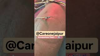 #naturopathy #acupuncture #niddle #neuro #acupuncturebenefits #ayurvedic #shortvideo#electrotherapy