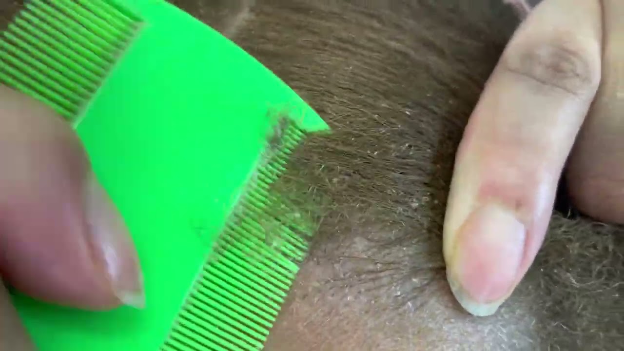 Come scratch my scalp with me 