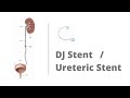 DJ stent stent / Ureteric stent