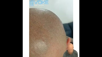 Scalp micropigmentation one year healed results at Evoke Hair Clinic, Sheffield