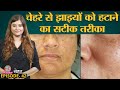 Face पर झाइयां यानी Melasma क्यों होता है और इससे हमेशा के लिए छुटकारा कैसे पाएं? | Sehat Ep 42