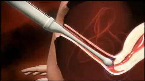 3D animation of how IVF works - DayDayNews