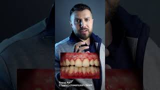 التهاب اللثة . الاسباب والعلاج periodontitis