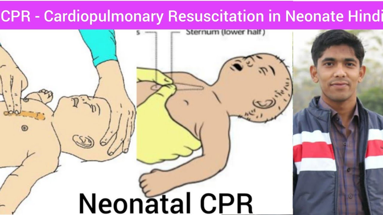 Neonatal CPR ( Cardiopulmonary Resuscitation ) in Hindi | How to Give CPR  in Neonatal | CPR Hindi - YouTube