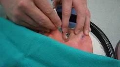 General Eye Surgery Info