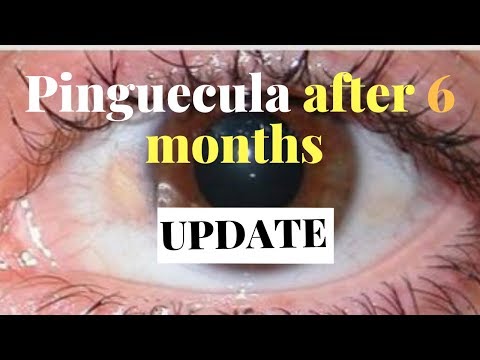 How I fight pinguecula yellow spot on eyes after 6 months update/NO MORE RADISH JUICE