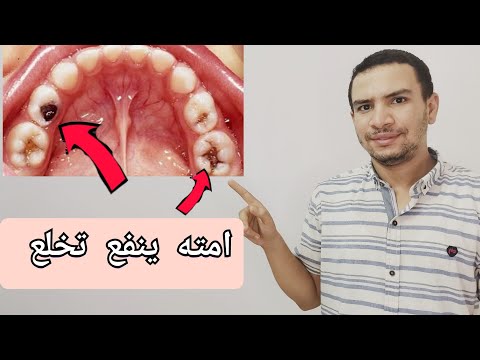 فيديو: هل هناك ضرس 4 سنوات؟