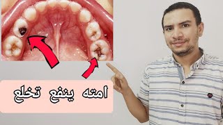 امته تخلع اسنان طفلك و انت مطمن /موعد تبديل اسنان الاطفال