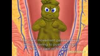 What Causes Hemorrhoids? Treatment and Cure.   Meditoons™